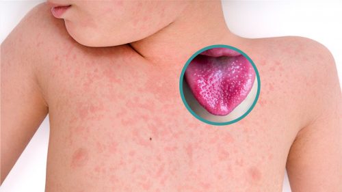 ¿Qué es la fiebre escarlatina? Talca confirmó cinco casos